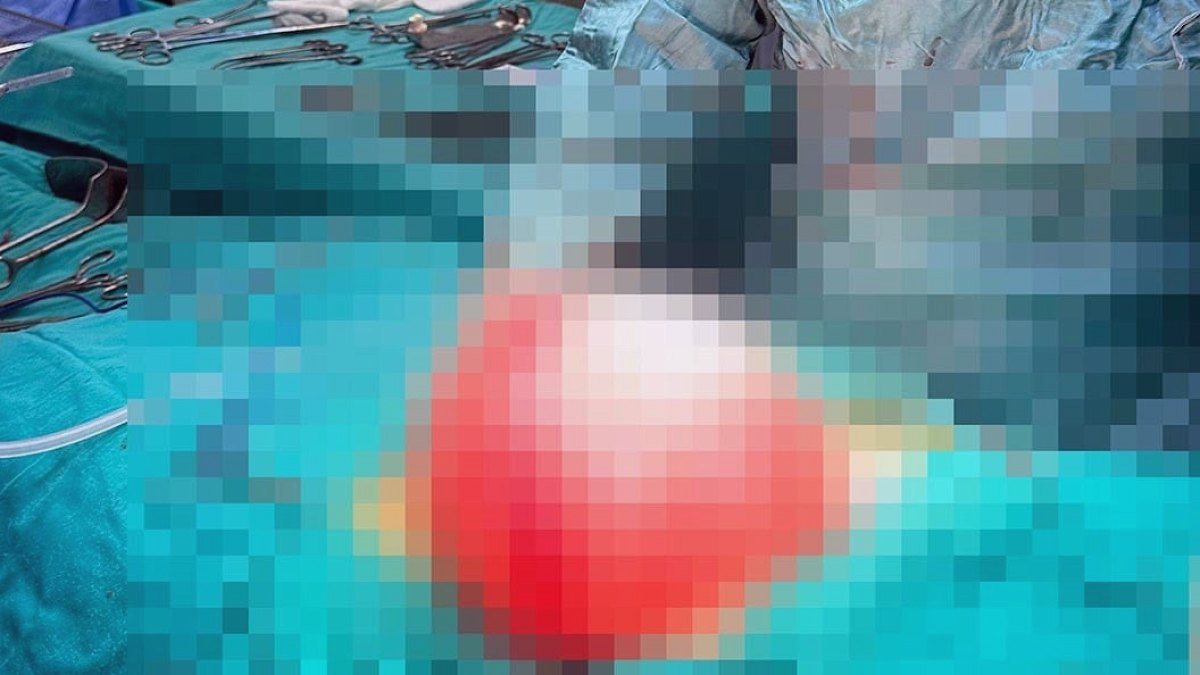 Kilolalarından kurtulmak için gitti, karnından 3,5 kilo kist çıktı
