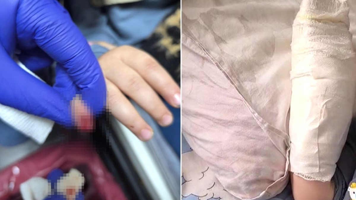 3 yaşındaki çocuğun yürüyen merdivende parmağı koptu