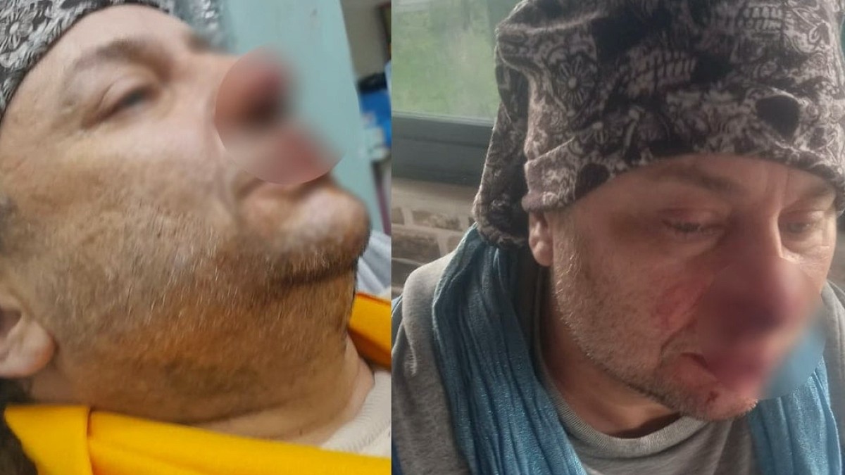 ''Felaket Tellalı'' lakaplı ünlü ismin pitbull saldırısında burnu koptu