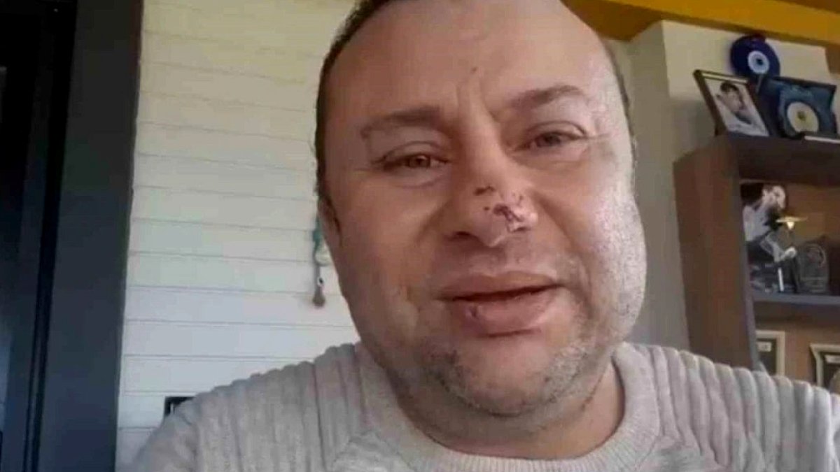 Pitbull saldırısında et yiyen bakteri bulaştı: İşte Onur Akay'ın son durumu