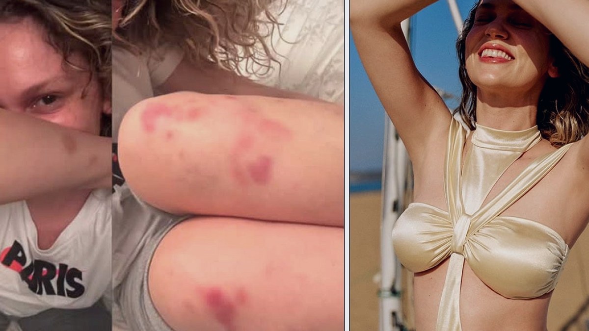 Vücudunun her yeri morardı: Farah Zeynep Abdullah’ın son paylaşımı endişelendirdi!