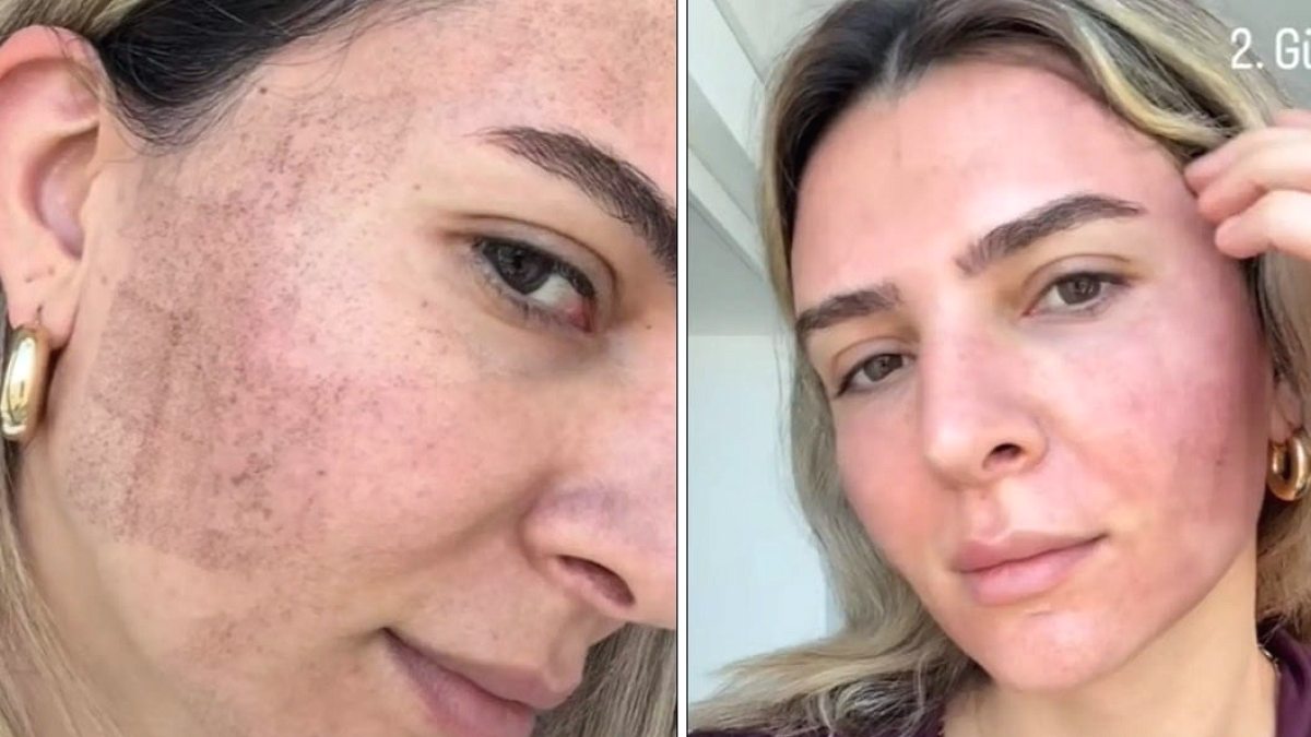 Merve Aydın'ın Lazerle Cilt Yenileme Sonrası Göz Kamaştıran Dönüşümü